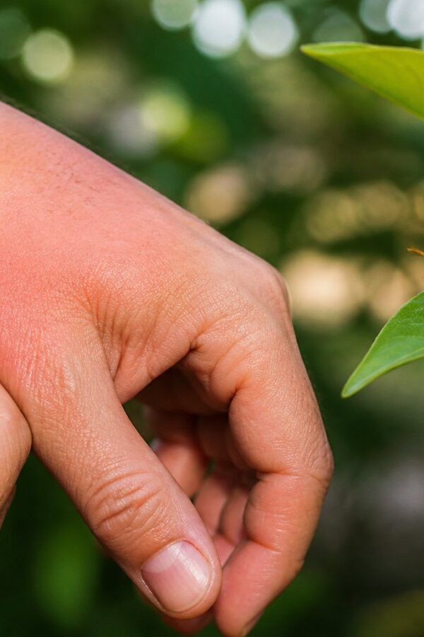 Mão de uma pessoa com vermelhidão e inchaço após picada de marimbondo, com o inseto próximo em uma folha verde.